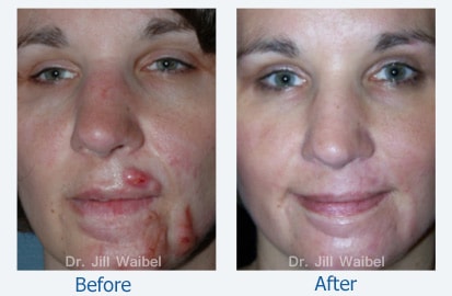 Steroid injection for acne scars