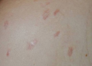 Hypertrophic scar treatment with steroids